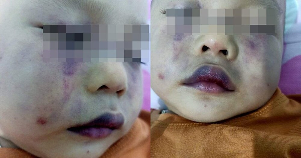Nghi vấn người phụ nữ ở cơ sở giữ trẻ bạo hành bé trai dã man khiến khuôn mặt bầm dập nặng Ảnh 3