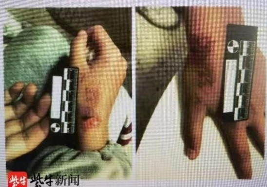 Học hành 'không đạt chuẩn của mẹ', bé gái 12 tuổi bị bạo hành dã man