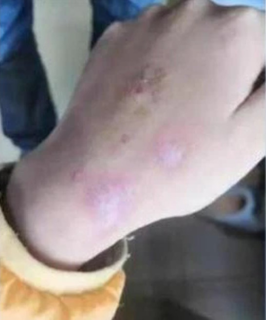 Học hành 'không đạt chuẩn của mẹ', bé gái 12 tuổi bị bạo hành dã man