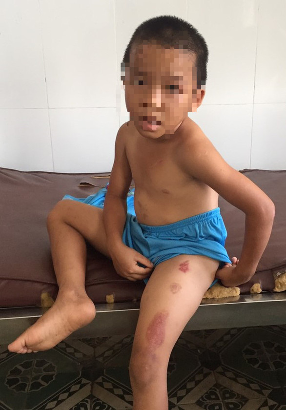 Khởi tố cha dượng bạo hành dã man, nhiều lần châm thuốc lá đang cháy vào con riêng của vợ