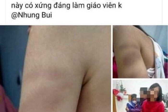 Dùng thước đánh tím tay học sinh lớp 1, cô giáo ở Hải Phòng bị đình chỉ dạy học một tuần Ảnh 1