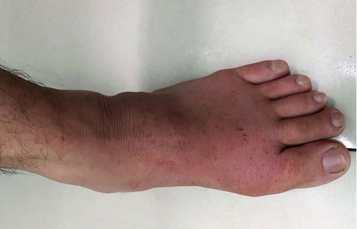 Vì sao nhiều người phát bệnh gút hoặc bị nặng lên sau kỳ nghỉ Tết?