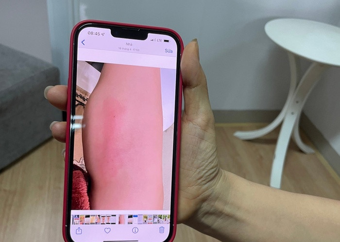 Chi 60 triệu tiêm 'collagen tươi' để làm thẳng chân, bắp chân người phụ nữ biến thành ổ áp xe
