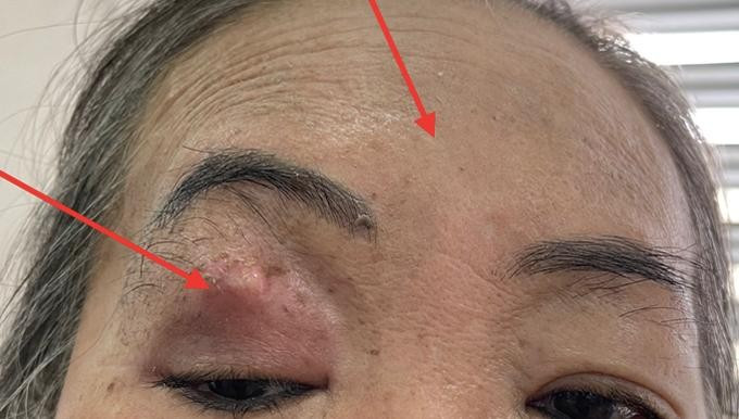 Bệnh nhân vào Bệnh viện Chợ Rẫy với triệu chứng đau đầu, sưng mắt, sưng trán bên phải sau đó được xác định bị hoại tử vùng mặt (Ảnh: Bệnh viện Chợ Rẫy).