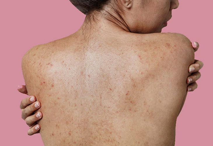 Bệnh viện Bạch Mai cứu sống cô gái suýt tử vong vì lăn kim trị mụn lưng - Ảnh 2.