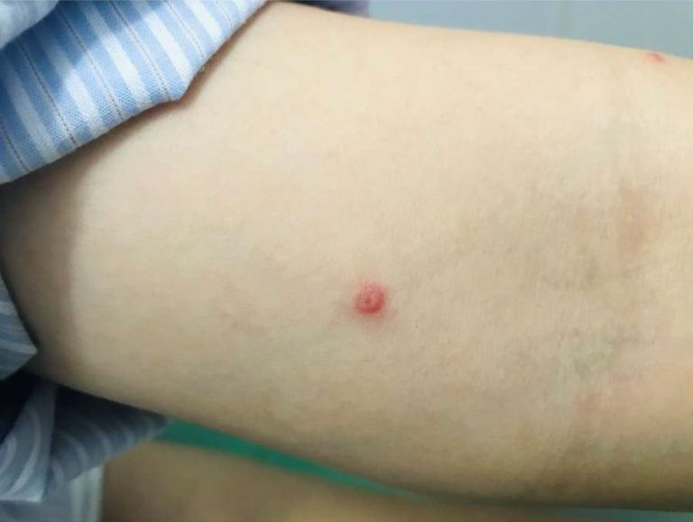 Công bố hình ảnh bóng nước ở bệnh nhân mắc đậu mùa khỉ giúp phân biệt với thủy đậu, chân tay miệng - Ảnh 1.