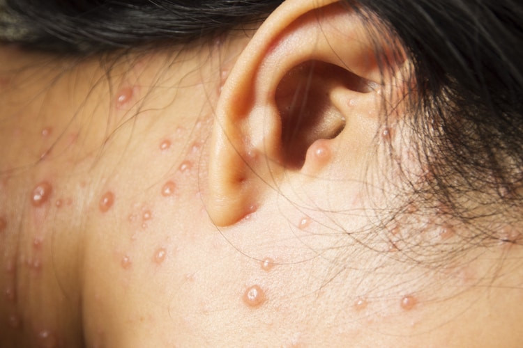 Dịch thủy đậu đang bùng phát mạnh trở lại: Cùng nghe chuyên gia phân tích và khuyến cáo cách phòng chữa bệnh - Ảnh 1.