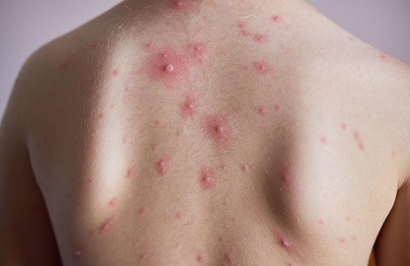 Dịch thủy đậu đang bùng phát mạnh trở lại: Cùng nghe chuyên gia phân tích và khuyến cáo cách phòng chữa bệnh - Ảnh 3.