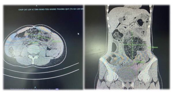 Kết quả chụp hình ảnh Cắt lớp vi tính (CT-Scan) phát hiện đoạn ruột phình to với kích thước 4,2 cm x 9,8 cm; 13,8 cm x 10,9 cm chứa nhiều bã thức ăn. Ảnh: BVĐK tỉnh Phú Thọ