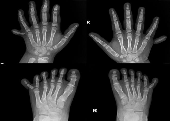 Bé gái có 12 ngón tay, 12 ngón chân cực hiếm gặp được phẫu thuật thành công Ảnh 1