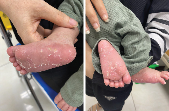 Bé trai 3 tháng tuổi mắc bệnh giang mai vì 1 nguyên nhân không ngờ Ảnh 1