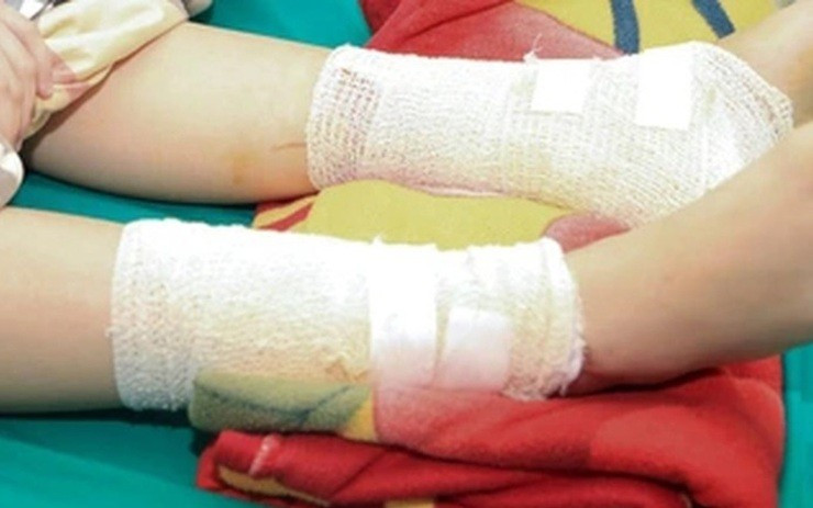 Bé gái 4 tuổi bị lửa cồn đốt bỏng nặng khắp người