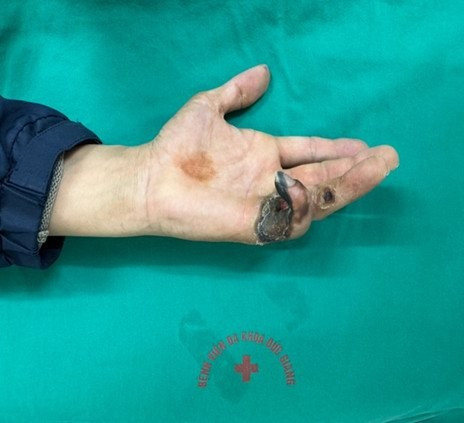 Sửa bình nóng lạnh, suýt mất ngón tay do bị điện giật