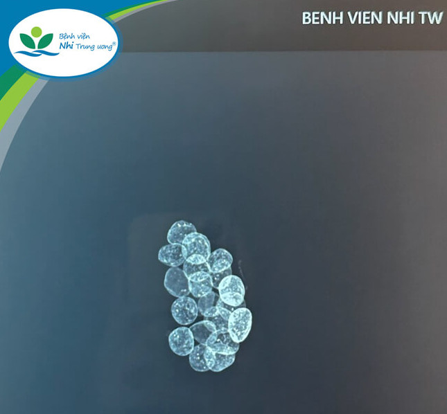 Cảnh báo tình trạng ngộ độc chì ở trẻ em