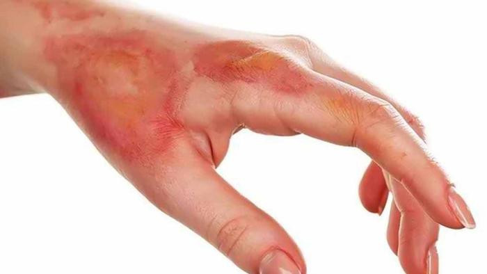 Xót xa bé gái bất ngờ bốc cháy vì người nhà nướng mực bằng cồn Ảnh 3