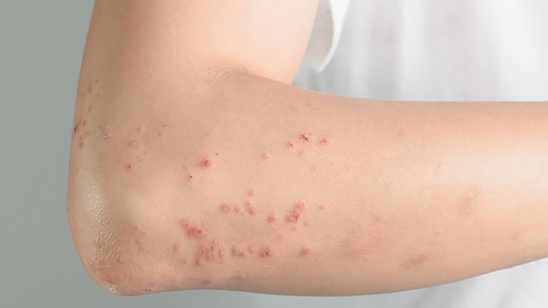 Uống nhiều nước tăng lực có thể gây dị ứng