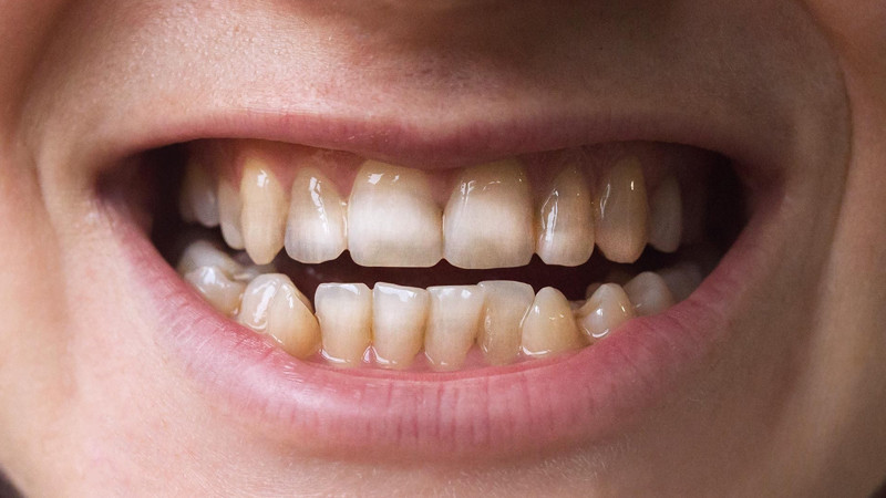 Uống nhiều nước tăng lực có thể làm hỏng răng