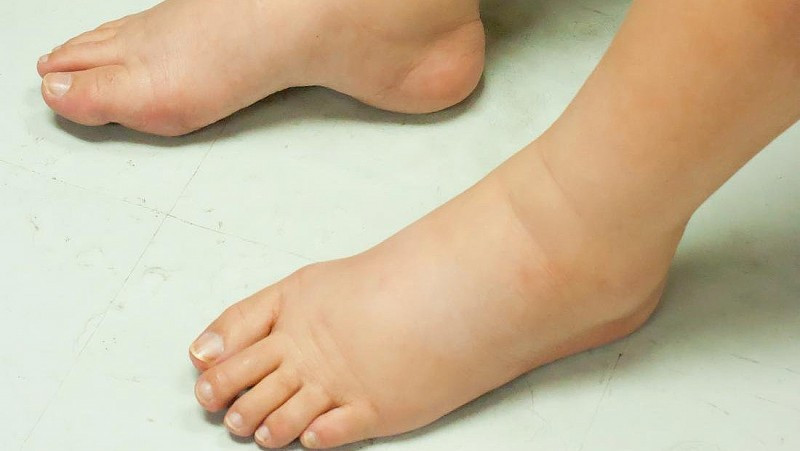 Phù nề toàn thân do uống thuốc nam không rõ nguồn gốc