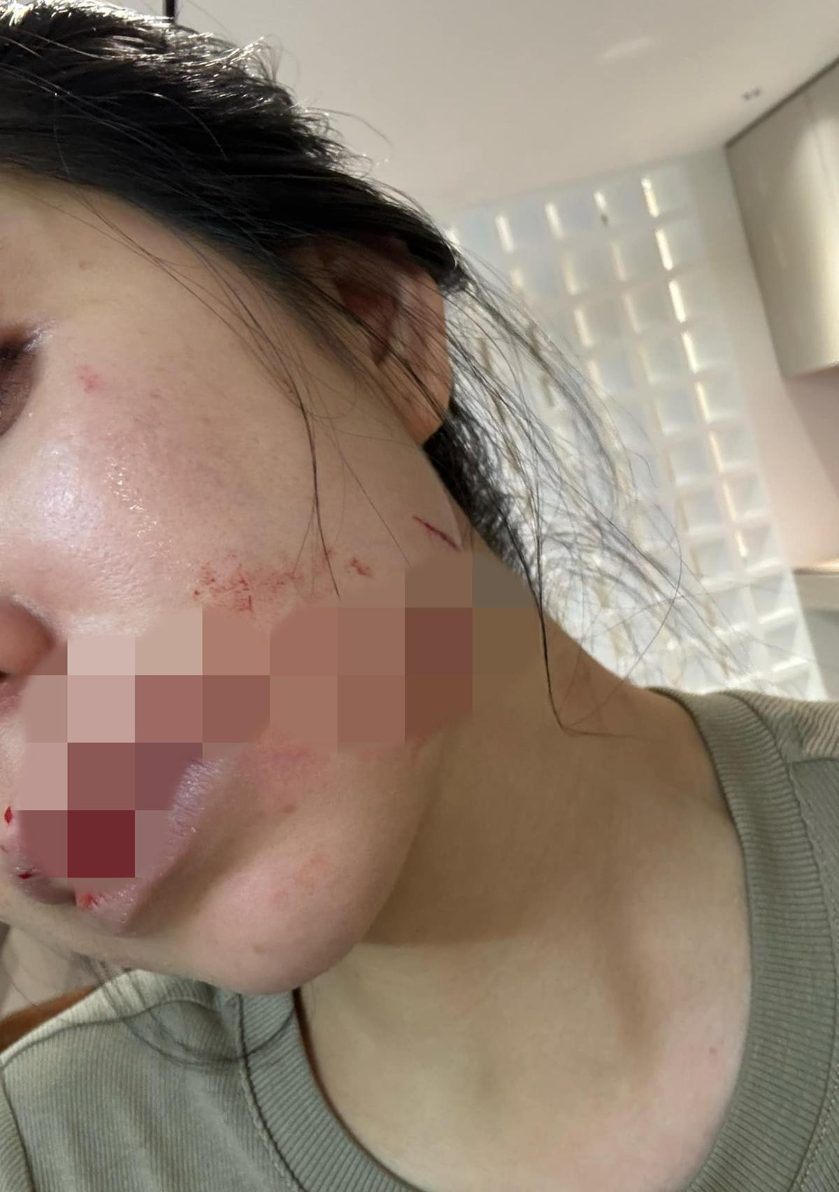 Hằng Du Mục công khai thương tích bị chồng tấn công, tiết lộ về phiên toà ly hôn Ảnh 3