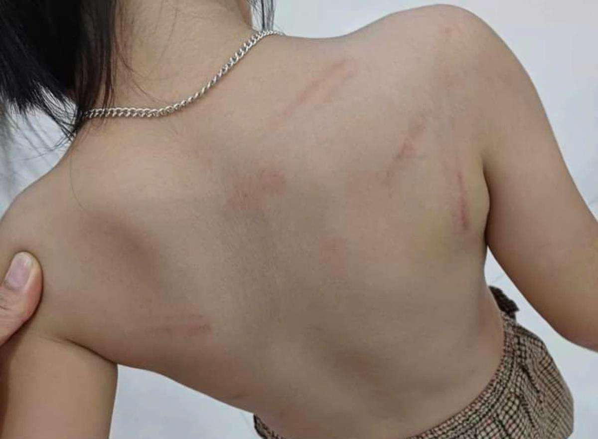 Vụ trẻ mầm non bị đánh bầm tím người: Trường học có động thái bất ngờ Ảnh 1