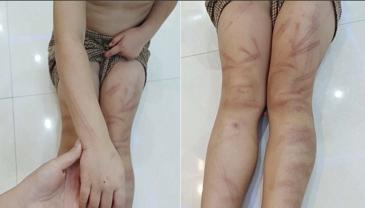 Vụ trẻ mầm non bị đánh bầm tím người: Trường học có động thái bất ngờ Ảnh 3