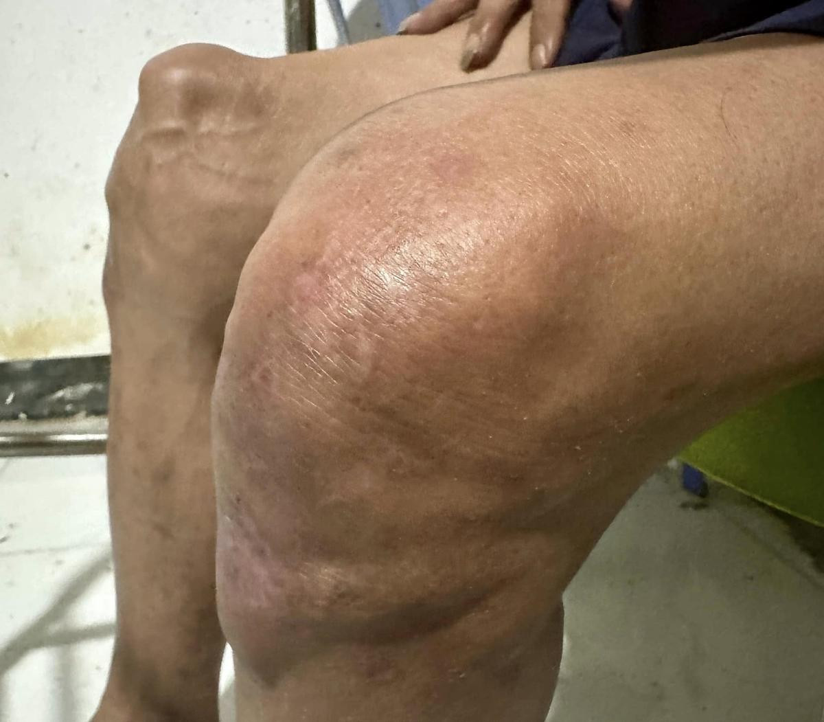 Tình trạng đáng lo của Thương Tín, có nguy cơ tàn tật ngồi xe lăn suốt đời Ảnh 3