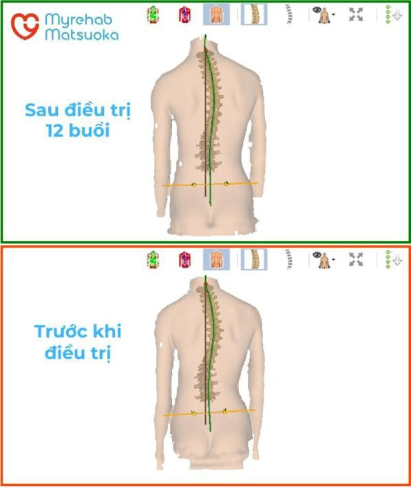Đưa cột sống cong vẹo trở lại bình thường bằng các bài tập và liệu pháp trị liệu - Chuyện có thật tại MYREHAB MATSUOKA