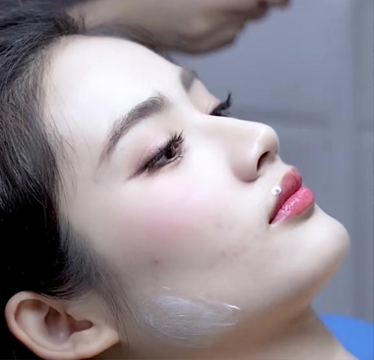 Hoa hậu Ý Nhi lại thẩm mỹ, xoá điểm đặc trưng nhất ở gương mặt Ảnh 1