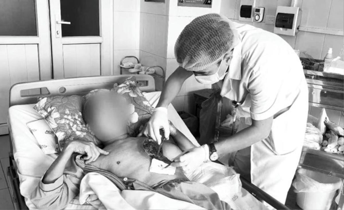 Người đàn ông hoại tử mô cơ ngực trái do nhiễm nấm sau khi dọn nghĩa trang cuối năm Ảnh 1