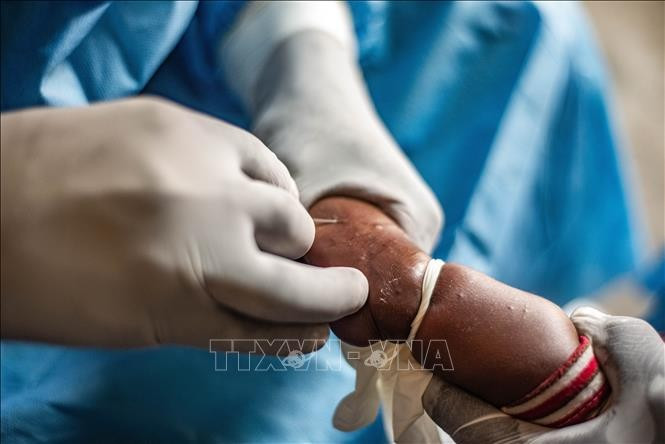 WHO duy trì tình trạng khẩn cấp y tế toàn cầu đối với bệnh đậu mùa khỉ ảnh 1
