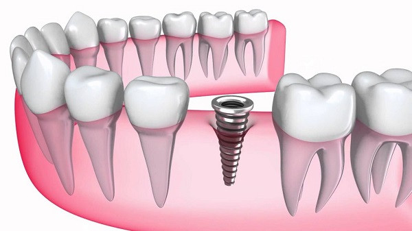 Trồng Implant – Ai phù hợp và những điều quan trọng cần biết!