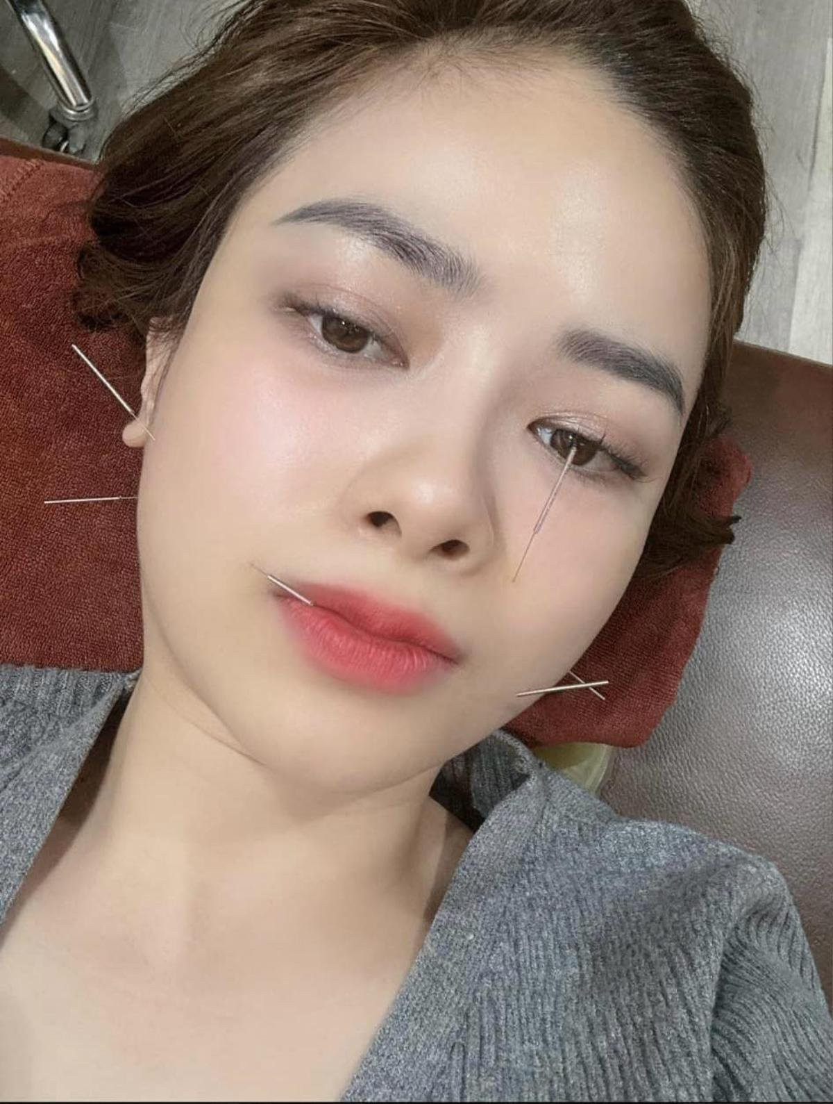 Dương Hoàng Yến nói rằng đã trải qua nhiều ngày châm cứu, nhưng vẫn chưa quen với nỗi đau của mũi kim châm. Ảnh: FBNV