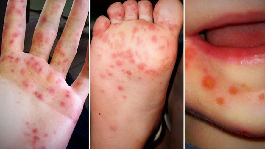 Hình minh họa bệnh tay chân miệng.