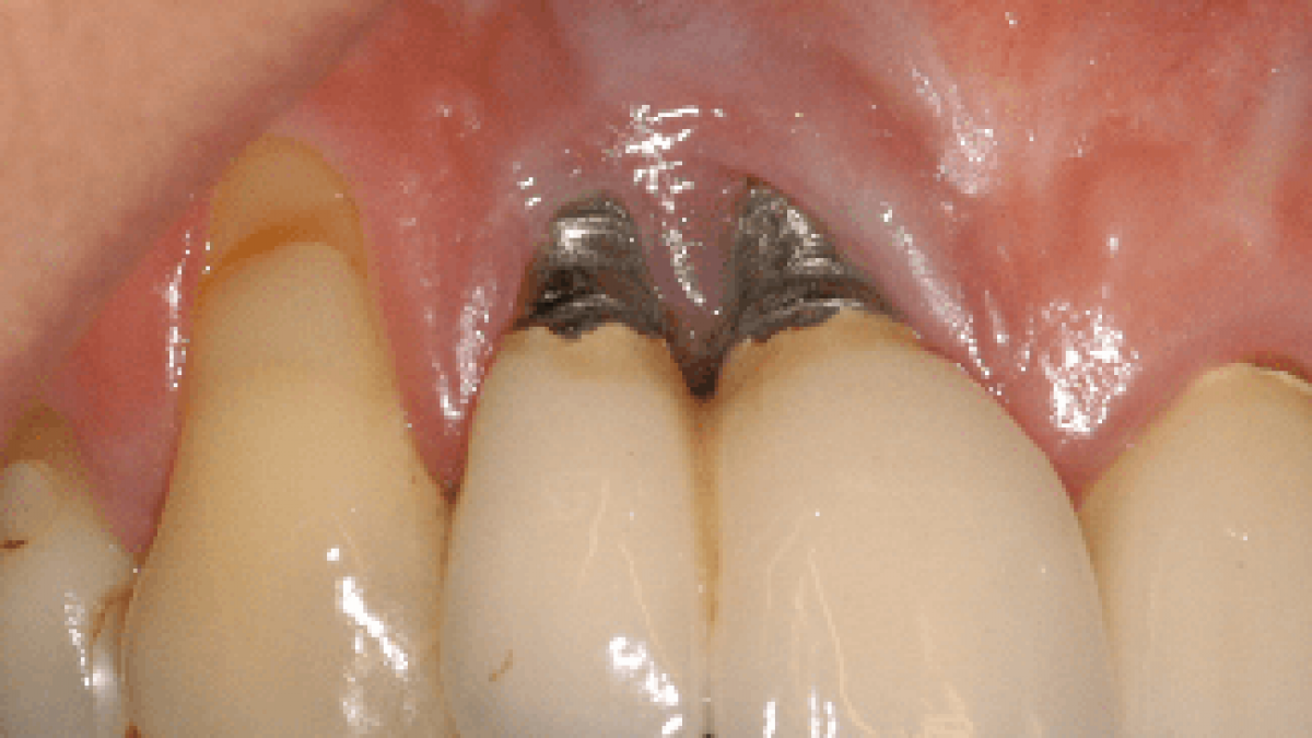 trong-rang-implant-co-gay-hoi-mieng-khong3-1747646161.png