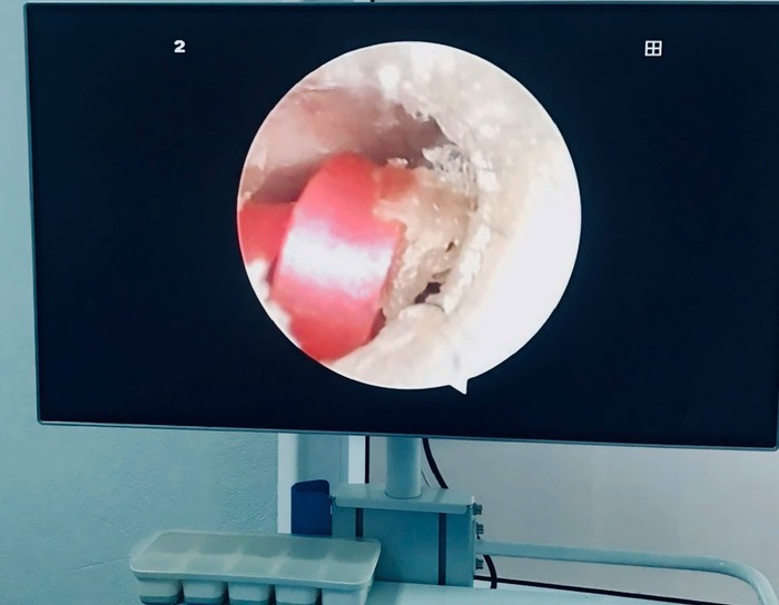 Các bác sĩ phát hiện sợi dây thun bên trong tai của bé gái.