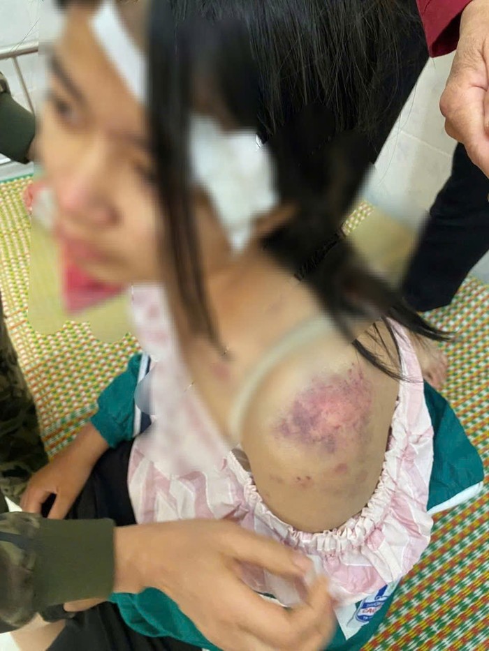 Cháu P.A với nhiều vết bầm tím trên cơ thể. Ảnh: Công an tỉnh Thái Nguyên