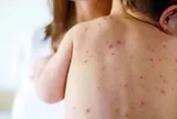 Cảnh giác với nguy cơ bệnh sởi "trở lại toàn cầu"
