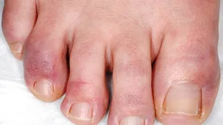 Cách khắc phục cước tay chân vào mùa Đông