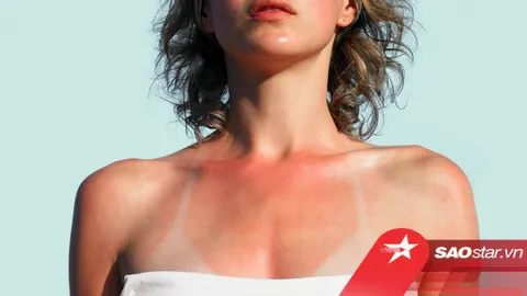 8 thói quen sai lầm khiến làn da cháy nắng càng thêm bong tróc, phồng rộp