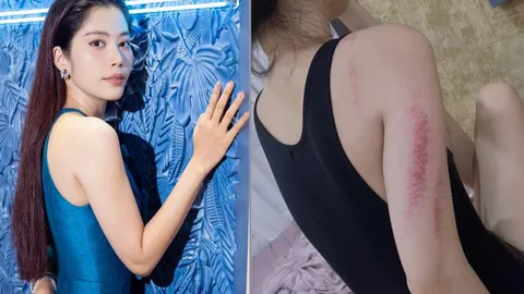 Nam Em lộ rõ thân hình gầy gò, nhiều vết bầm tím trên cơ thể khiến fan lo lắng