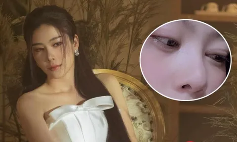 Nam Em gây lo lắng với gương mặt hốc hác, mắt sưng vù: Chuyện gì đang xảy ra?