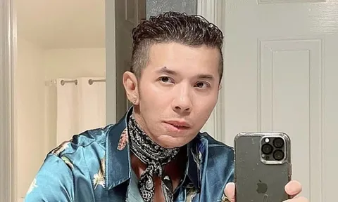 Ca sĩ Kasim Hoàng Vũ mặt biến dạng, tiết lộ vừa phải phẫu thuật xương hàm