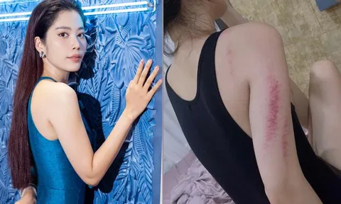 Nam Em lộ rõ thân hình gầy gò, nhiều vết bầm tím trên cơ thể khiến fan lo lắng