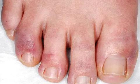 Cách khắc phục cước tay chân vào mùa Đông