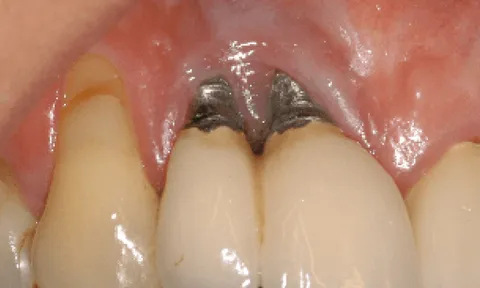 Trồng răng Implant có gây hôi miệng không? Lời khuyên từ chuyên gia