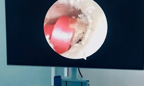 Bé gái 6 tuổi suýt thủng màng nhĩ vì sợi dây thun