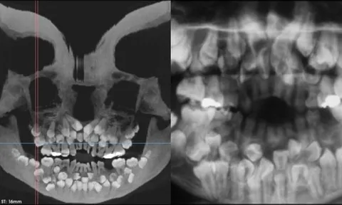 Bé gái 11 tuổi mọc 81 chiếc răng