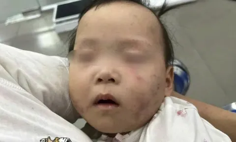 Bé gái 1 tuổi bầm tím mặt khi gửi nhà trẻ, mẹ bức xúc trình báo Công an: Bảo mẫu bị tạm giữ