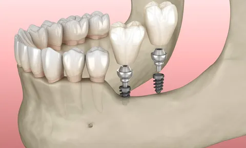 Phân biệt Minivis và Implant thông thường trong chỉnh nha