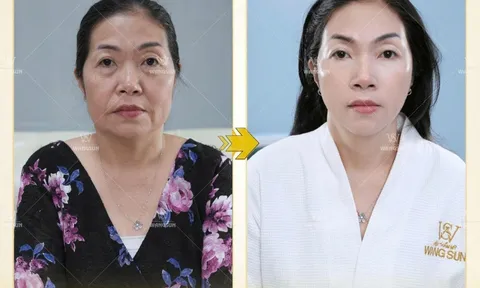 “Tam giác vàng” giúp “trẻ lại cả thập kỷ” - Khám phá 3 công nghệ thẩm mỹ được yêu thích nhất tại WangSun